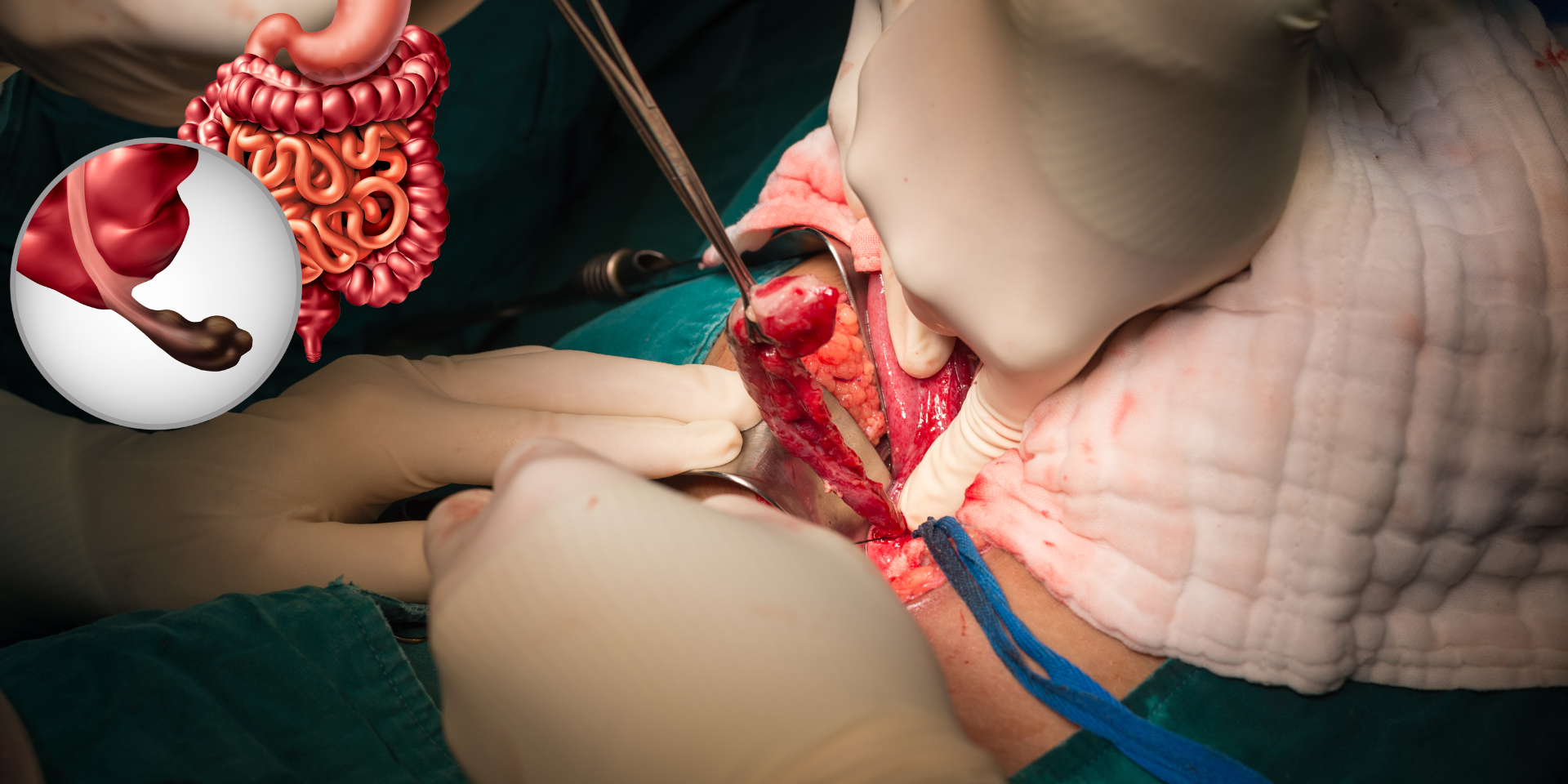 Affordable appendix surgery in Kim & Ankleshwar