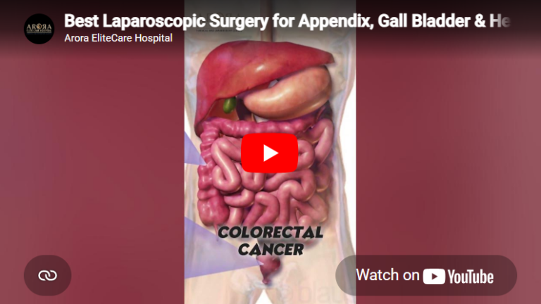 Best Laparoscopic Surgery for Appendix, Gall Bladder & Hernia Arora Elite Care Hospital Surat