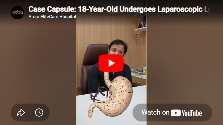 Laparoscopic Lymph Node Excision with Appendicitis