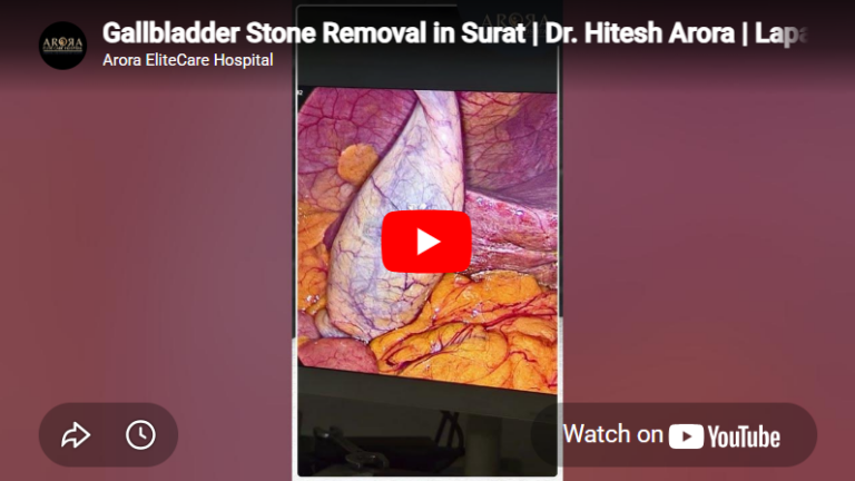 Gallbladder Stone Removal in Surat