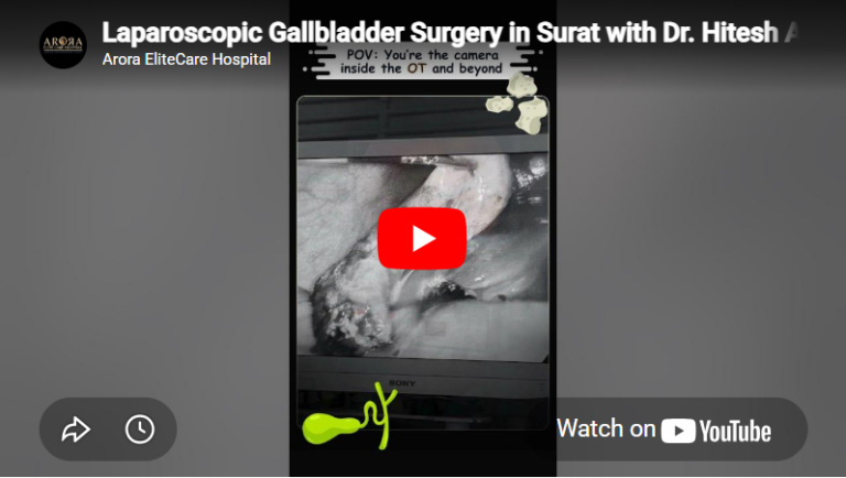 Laparoscopic Gallbladder Surgery in Surat with Dr. Hitesh Arora