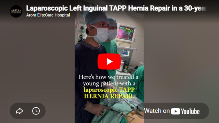 Laparoscopic Left Inguinal TAPP Hernia Repair in a 30-year-old male by Dr. Hitesh Arora