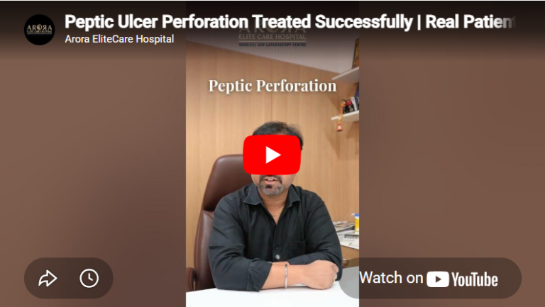 Peptic Ulcer Perforation Treated Successfully