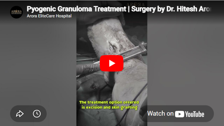 Pyogenic Granuloma Treatment Surgery by Dr. Hitesh Arora – Arora Elite Care Hospital