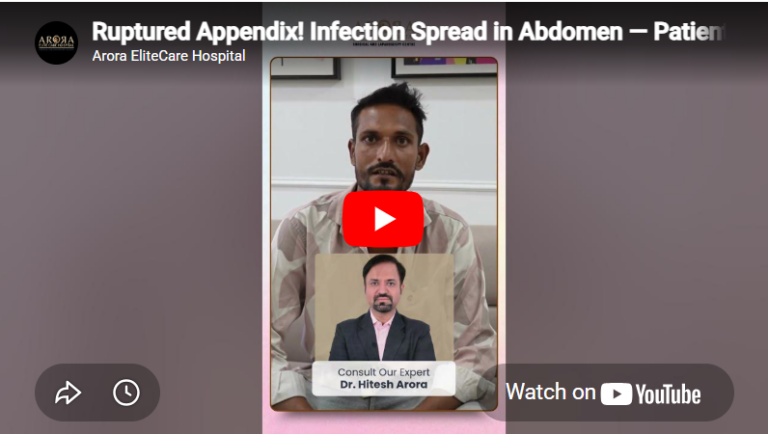Ruptured Appendix! Infection Spread in Abdomen - Patient Shares Recovery Story Dr. Hitesh Arora