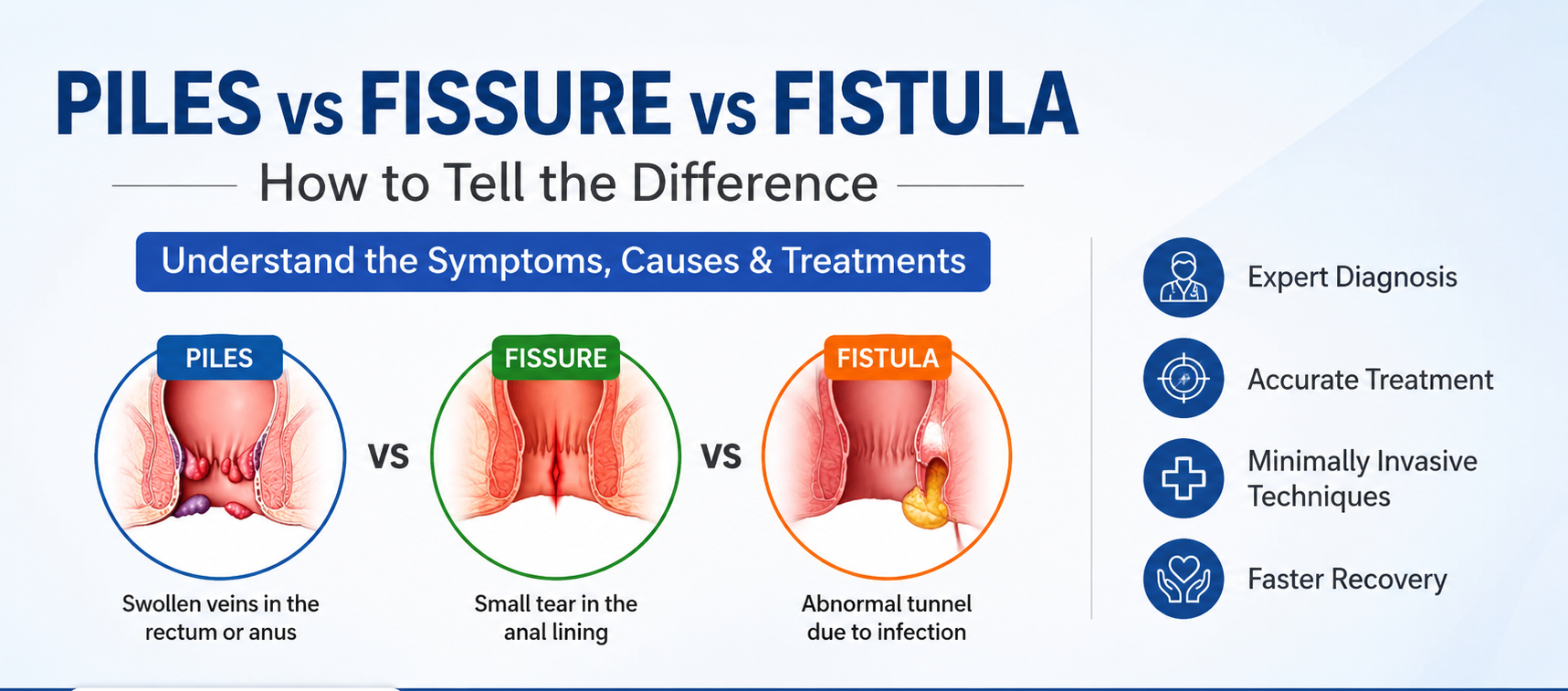difference between piles fissure fistula