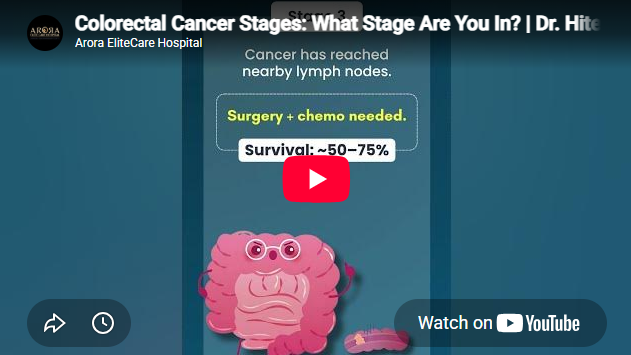 Colorectal Cancer Stages