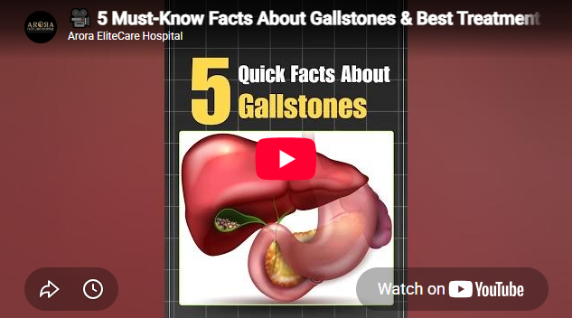 Gallstones