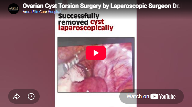 Ovarian Cyst Surgery in Surat