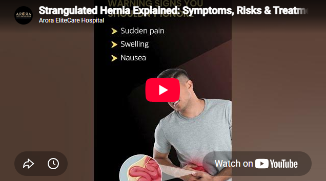 Strangulated Hernia