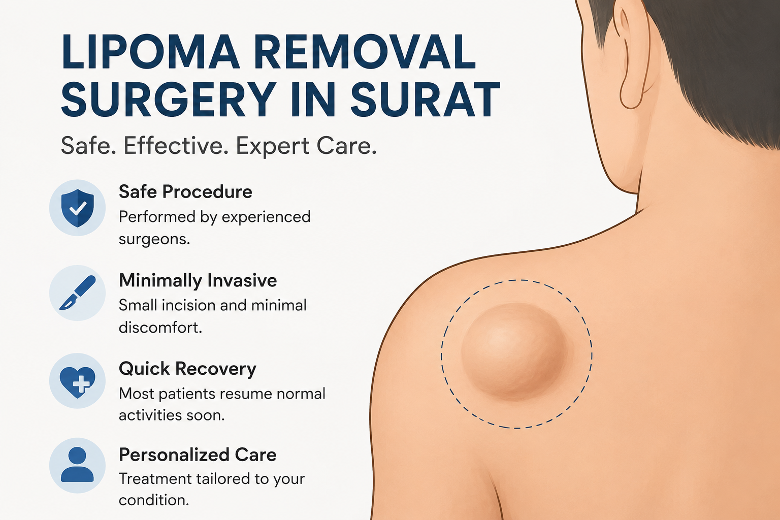Lipoma Removal Surgery in Surat