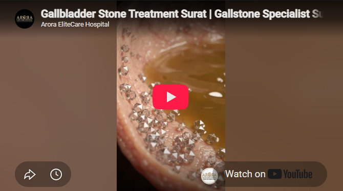 Gallbladder Stones Treatment in Surat
