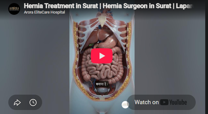 Hernia Treatment in Surat