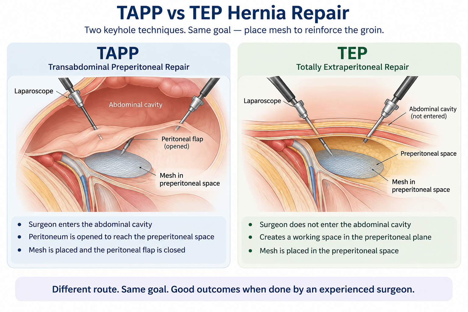 tapp surgery